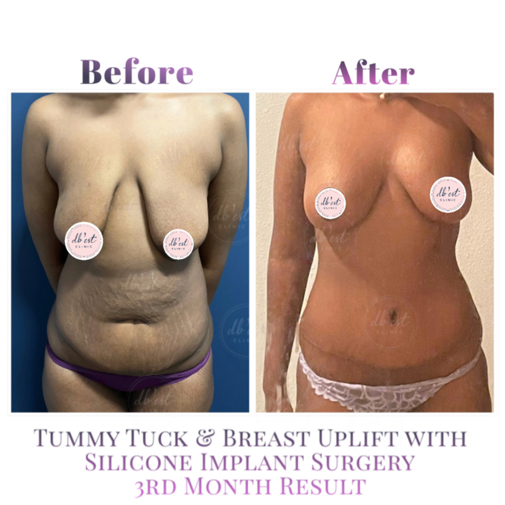 Before and After Result